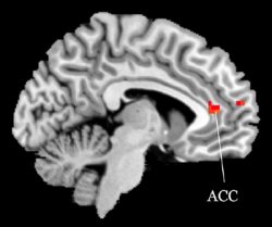 Increased activity in the anterior cingulate cortex after 2 weeks of IBMT