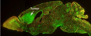 image shows tumor forming in a MADM-mouse brain section