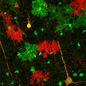 image of earliest ever view of emerging glioma in the brain