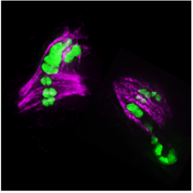 defective segregation of meiotic chromosomes (green) with excess crossovers 